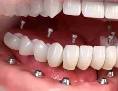 smile makeover delray beach with implants 1 -Ocean Breeze