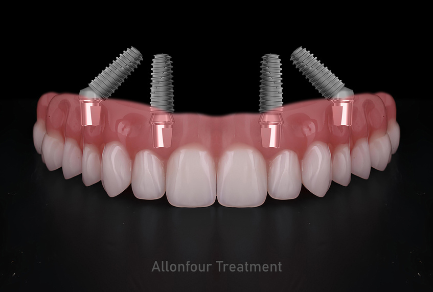 In dental implant surgery, the All-on-Four, All-on-4, and All-on-X treatments involve placing full-arch dental prostheses on cylindrical titanium implants applied to the upper jaw. Dental before after