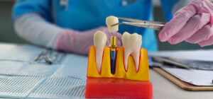 Doctor hold dental implant, artificial tooth roots into jaw, root canal of dental treatment
